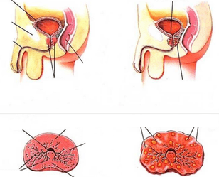 normálna prostata a chronická prostatitída