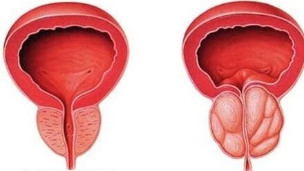 normálna a zapálená prostata