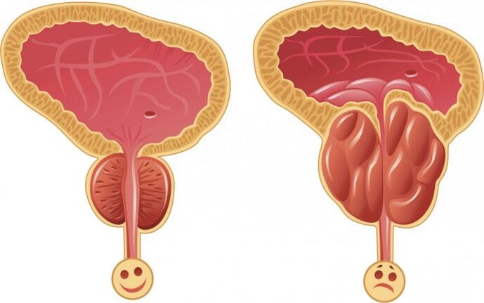 zdravá a zapálená prostata s prostatitídou