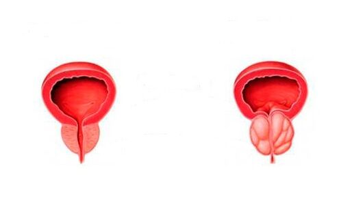 zdravá a zapálená prostata s prostatitídou