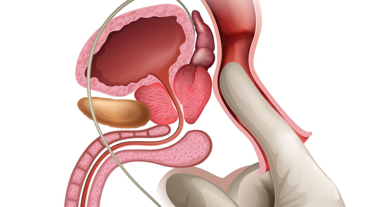 Masáž prostaty je účinný spôsob liečby kongestívnej prostatitídy